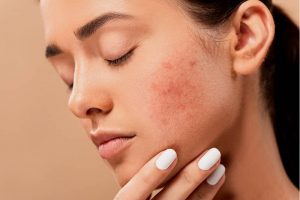 Huile de jojoba pour l'acné